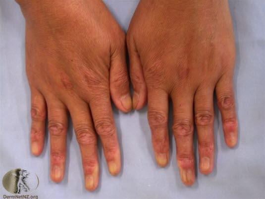 Systemisk sklerose 2