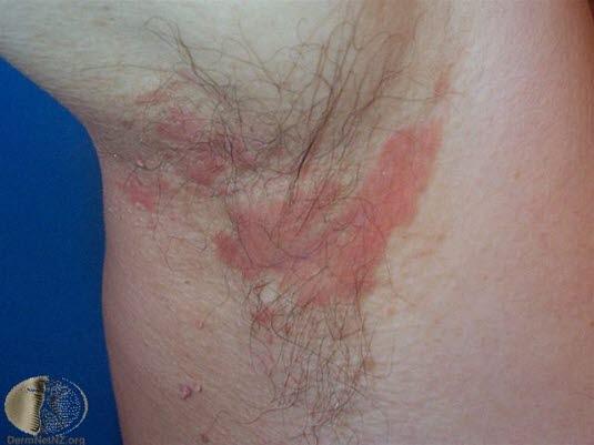 Seboroisk eksem, aksille