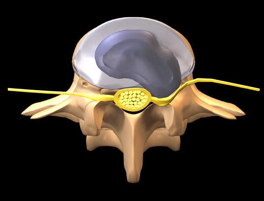 Væske fra mellomvirvelskiven trykker mot nerven