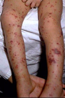 Hudblødninger ved meningokokkmeningitt.