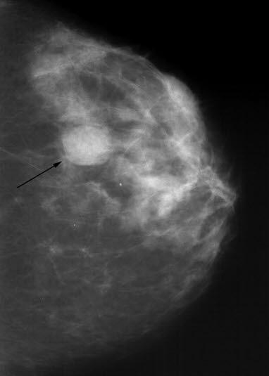 Mammografi, cyste