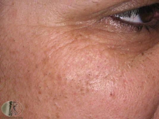 Akne, åpne komedoner