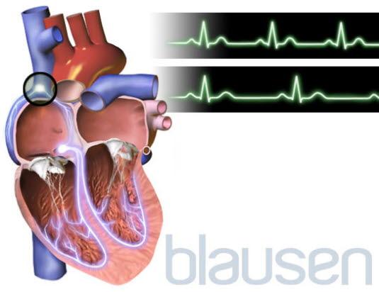 Bradykardi - langsom puls