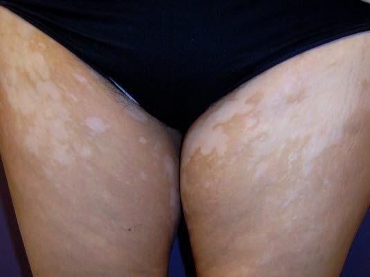 Vitiligo