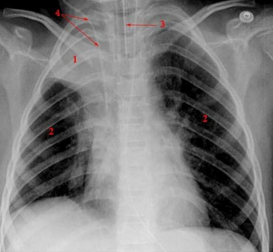 Lunger med atelektase