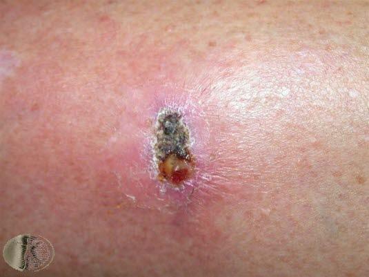 Stikkskade, infisert