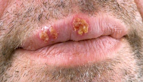 Bilde av herpes simplex 1 lesjon på leppe, mann