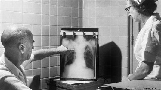 Foto: PHIL- CDC: Lege og sykepleier observerer et røntgenbilde av en tuberkulosepasient.