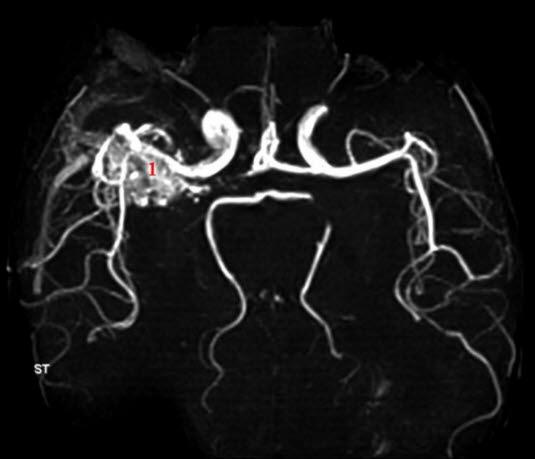 AV-malformasjon (MR angio)