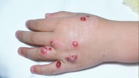 Orf disease hand, lesions