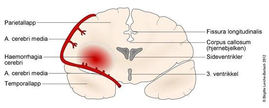 intracerebral bleeding