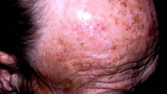Actinic keratosis