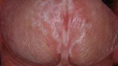 Lichen sclerosus, penis