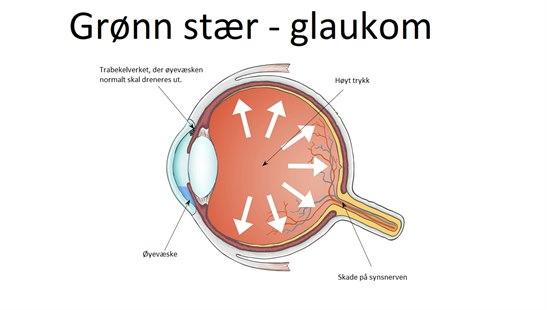 Glaucoma
