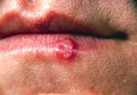 Herpes simplex