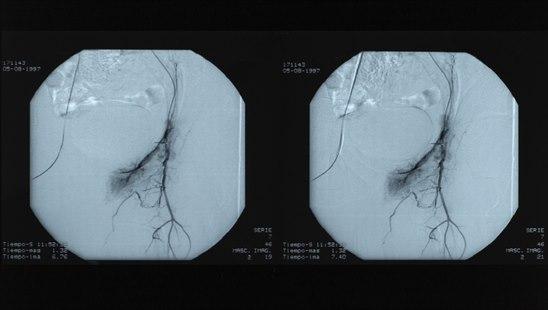 Vascular radiography