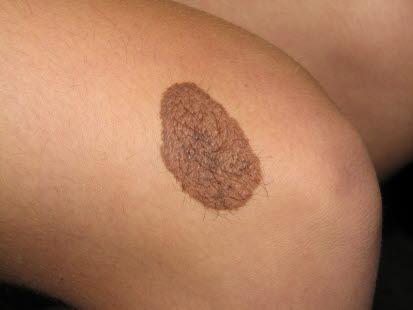 Nevus, medfødt