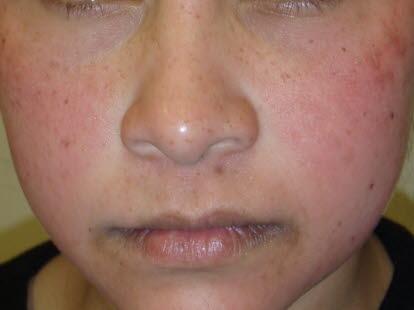 Fifth disease, erythema infectiosum, face