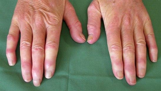 Raynauds fenomen 1280x725