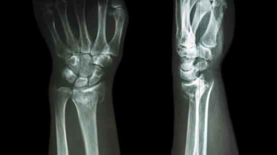 Distal radius fracture