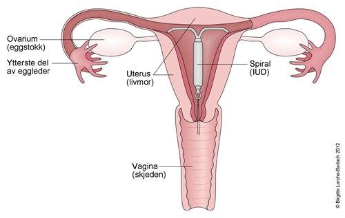 Spiral inne i livmoren