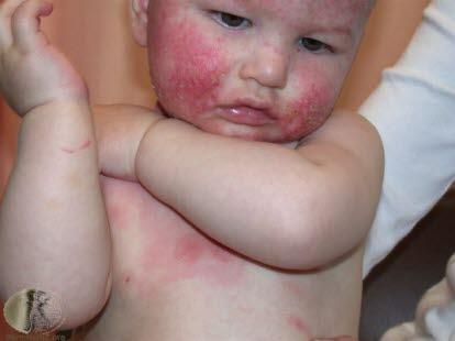 Atopic dermatitis, baby