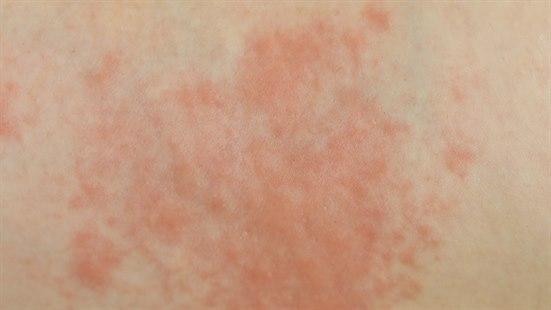 Allergic rash
