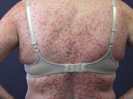 Guttat psoriasis