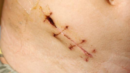 Appendectomy scar