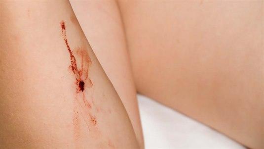 Nærbilde av et bitt som er på underarmen til en pasient