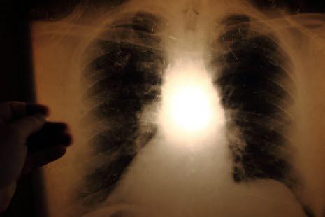 X-ray lungs