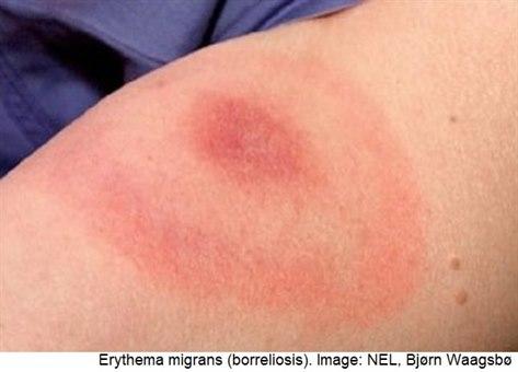Erythema migrans