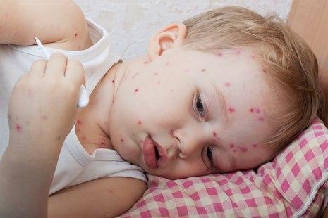 Chickenpox