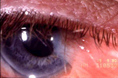 Pterygium conjunctivae