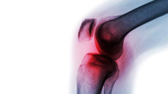 osteoarthritis