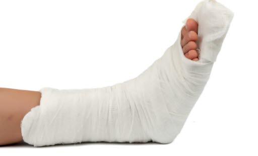Både gips og støttebandasje rundt en ankel