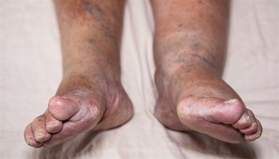 Edema lower leg