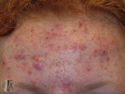 Acne, macrocomedones