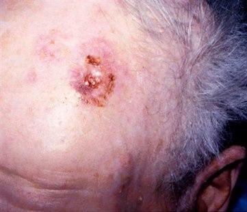 Squamous cell skin cancer, head