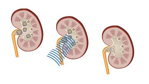 Sjokkbølgebehandling