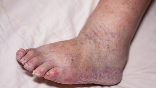 Edema ankle