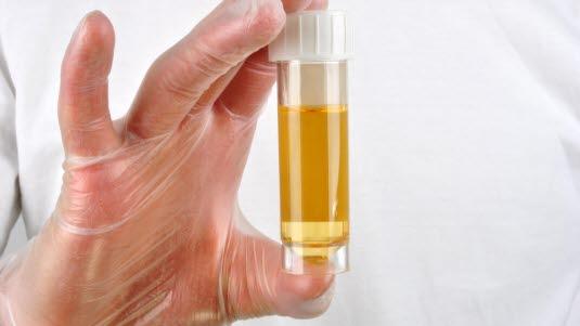 Nærbilde av en hånd som holder en urinprøve