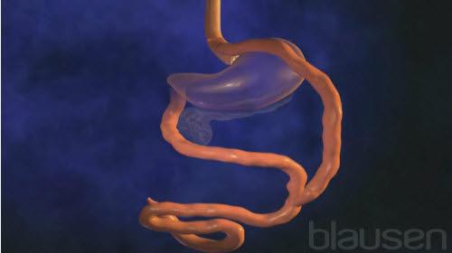 roux_en_y_gastrisk_bypass.jpg