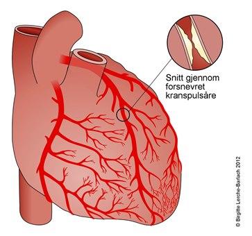 Innsnevret kransåre