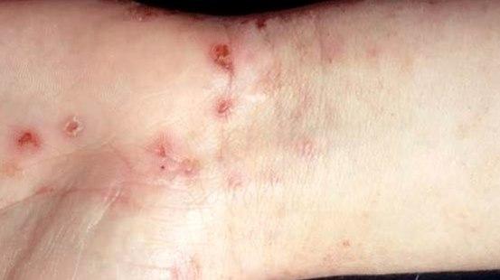 Scabies, skin lesions