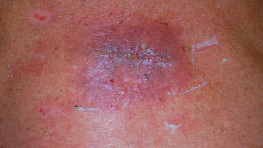 Kirurgisk sårinfeksjon.jpg