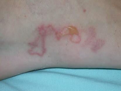 Larva migrans, skin