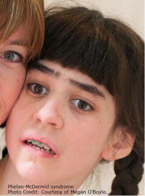 Phelan-McDermids syndrom Phelan-McDermids syndrom