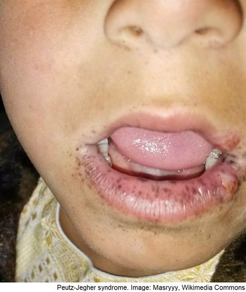 Preutz-Jegher syndrom Preutz-Jegher syndrom
