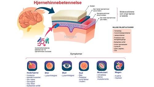 Hjernehinnebetennelse.jpg Hjernehinnebetennelse.jpg